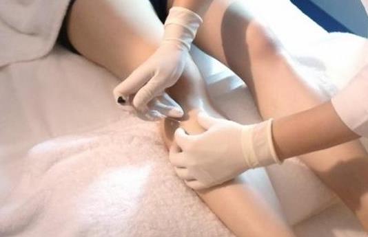 埋線減肥會留疤痕嗎?埋線減肥一個療程要做幾次?