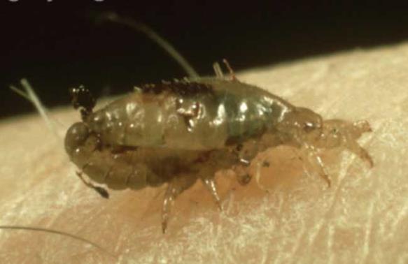 虱子為什么會咬人?身上生虱子怎么辦?如何能預防生虱子?