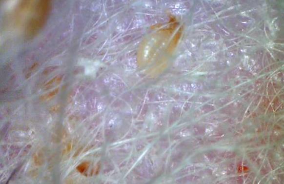虱子為什么會咬人?身上生虱子怎么辦?如何能預防生虱子?