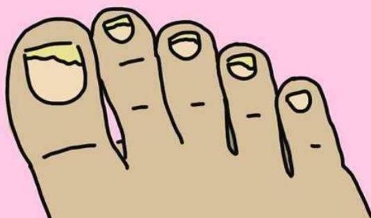 哪些人容易患灰指甲?灰指甲的日常護(hù)理有哪些?