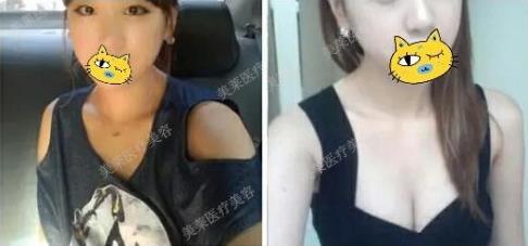 佛山美萊整形柯吟笑:有技術懂審美的內窺鏡隆胸醫(yī)生