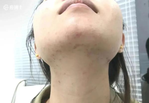最美教師蒞臨|| 痘博士百余家門店因教師節公益活動引爆!