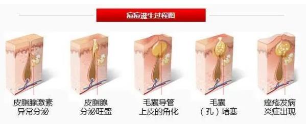 博士說痘||除痘根之逼進痘痘老巢的清剿 ——細說細胞祛痘之五
