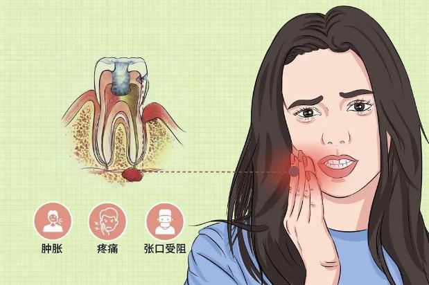 全民愛牙公益-智齒牙發(fā)炎有哪些炎癥呢