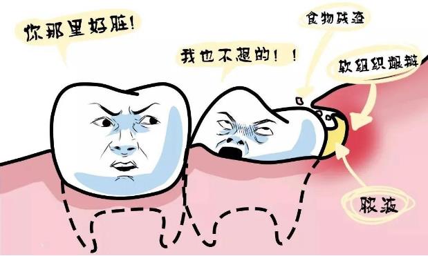 全民愛牙公益-智齒牙發(fā)炎有哪些炎癥呢