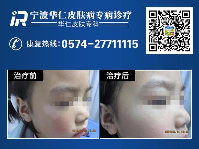 寧波白癜風醫院:孩子是白癜風易發群體嗎?