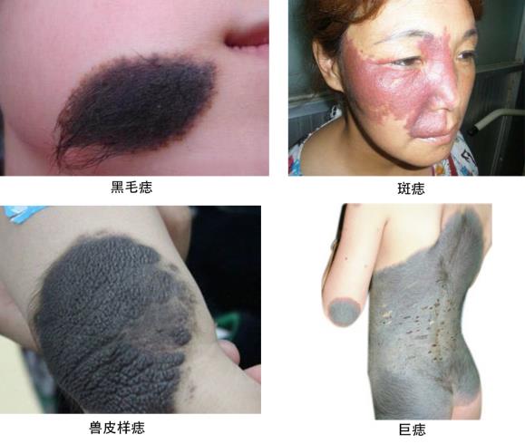黑毛痣用激光好還是手術切除好?