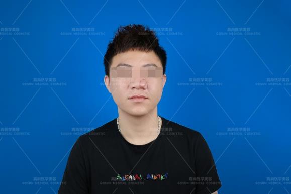 黑毛痣用激光好還是手術切除好?