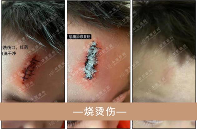 抖梵皙疤痕修護事業萬億市場來襲