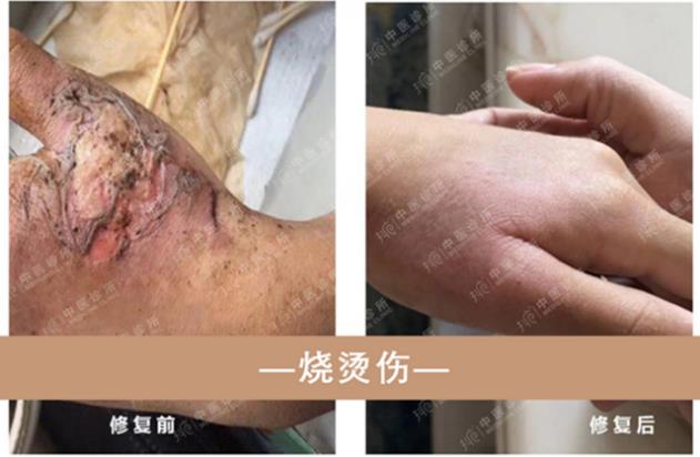 抖梵皙疤痕修護事業萬億市場來襲