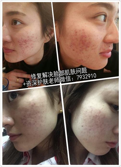國產祛痘護膚品哪個好?到底哪種產品真正祛痘?