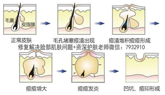 比較安全的祛痘印產品:朵嘉濃到底能修復皮膚嗎?