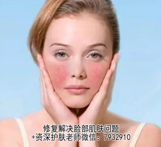 臉過敏嚴重紅腫怎么辦?朵嘉濃的護膚品真的能修復好皮膚嗎?
