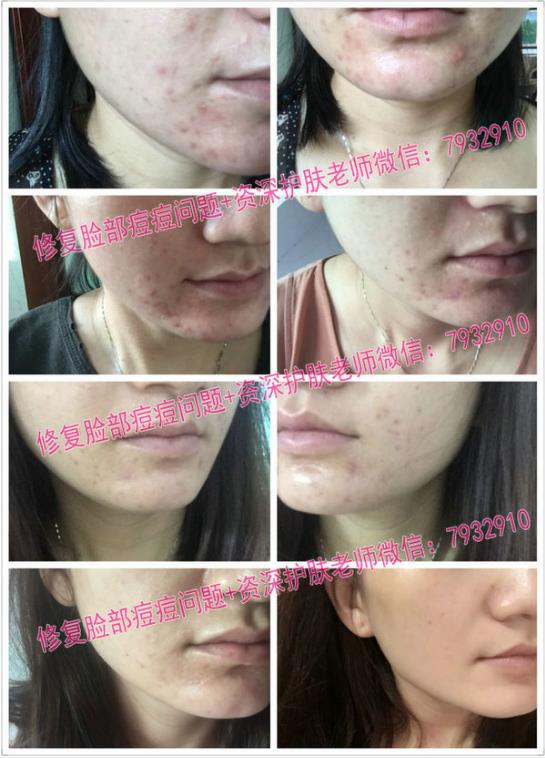比較安全的祛痘印產品:朵嘉濃到底能修復皮膚嗎?