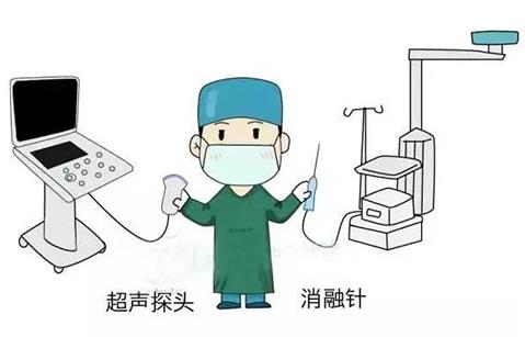 濟南顯微外科醫(yī)院為20歲甲狀腺結節(jié)患者消融治療,美觀無疤痕