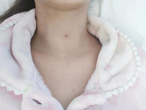 濟南顯微外科醫(yī)院為20歲甲狀腺結節(jié)患者消融治療,美觀無疤痕