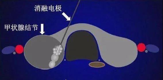濟南顯微外科醫(yī)院為20歲甲狀腺結節(jié)患者消融治療,美觀無疤痕