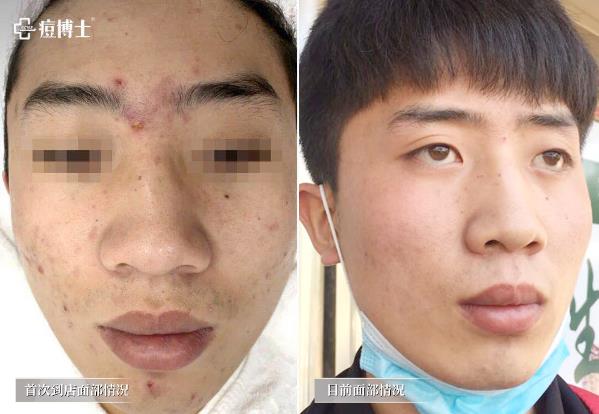 公益行動||跨越69座城,痘博士為痘友都做了么?