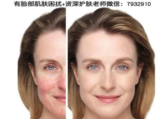 我的臉過敏了怎么辦?臉過敏后毛孔粗大如何解決?
