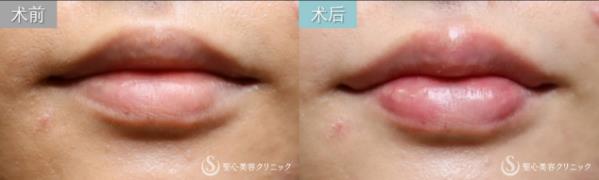 日式整形醫生解析:如何擁有日本女明星般的日式精致臉?