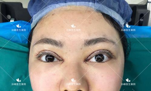 西京孫峰醫(yī)生在西安國(guó)際醫(yī)學(xué)中心坐診成功參加學(xué)術(shù)會(huì)手術(shù)演示