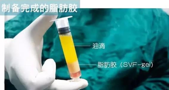 福州名韓整形徐麗麗:早點做脂肪膠填充的好處