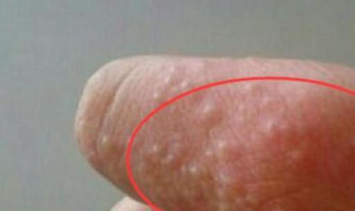 怎么預防手指長小水泡?手指脫皮的原因有哪些?