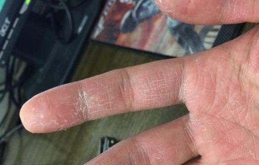 怎么預防手指長小水泡?手指脫皮的原因有哪些?
