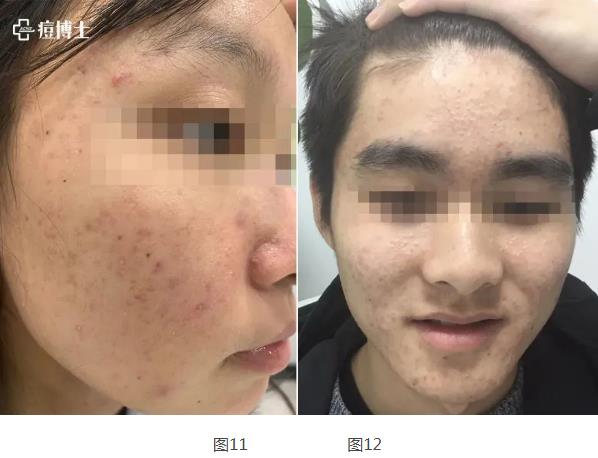 博士說痘||博士總結出痘痘8種造坑大法!試看痘痘在老巢怎么作之二——細說細胞祛痘之七