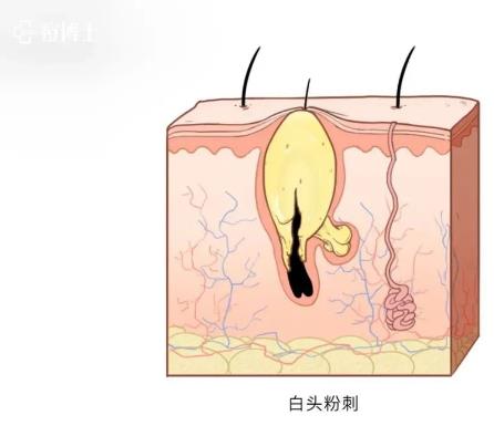 博士說痘||博士總結出痘痘8種造坑大法!試看痘痘在老巢怎么作之二——細說細胞祛痘之七