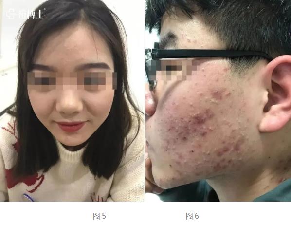 博士說痘||博士總結出痘痘8種造坑大法!試看痘痘在老巢怎么作之二——細說細胞祛痘之七