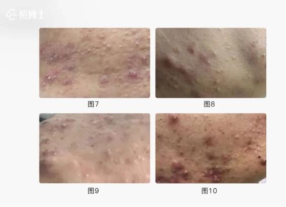 博士說痘||博士總結出痘痘8種造坑大法!試看痘痘在老巢怎么作之二——細說細胞祛痘之七
