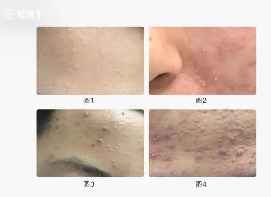博士說痘||博士總結出痘痘8種造坑大法!試看痘痘在老巢怎么作之二——細說細胞祛痘之七
