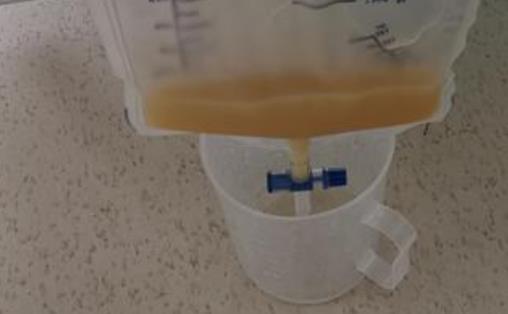 什么是乳糜尿?為什么會患乳糜尿?