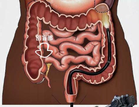 腸結核會傳染嗎?腸結核的癥狀是什么