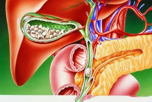 如何預防膽囊息肉?膽囊息肉的危害