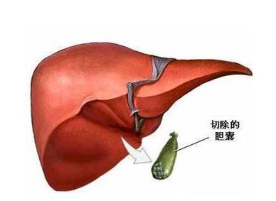 如何預防膽囊息肉?膽囊息肉的危害