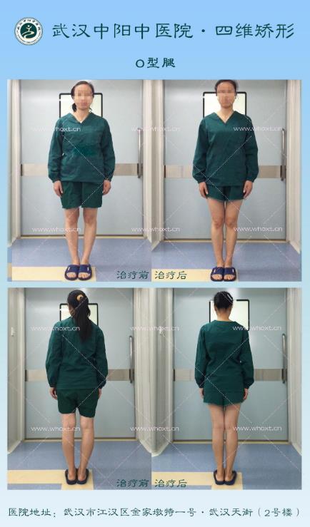 怎樣使X型腿變直?武漢中陽中醫醫院“四維矯形”技術無痕矯正