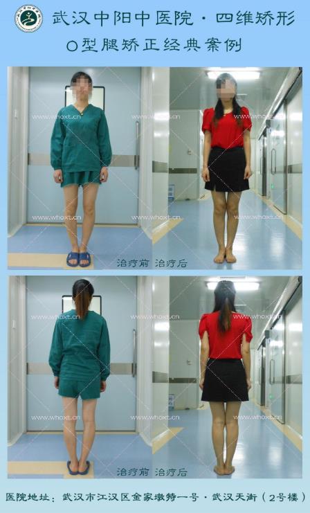 怎樣使X型腿變直?武漢中陽中醫醫院“四維矯形”技術無痕矯正