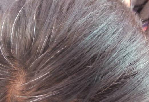 白發病可以治愈嗎?引起頭發早白的原因有哪些?