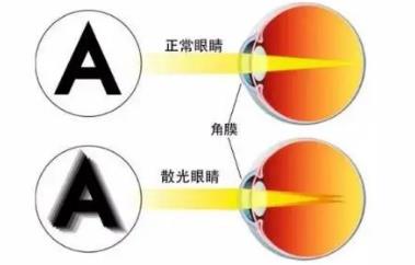 遠程視覺謝培英;散光屬于屈光不正的一種