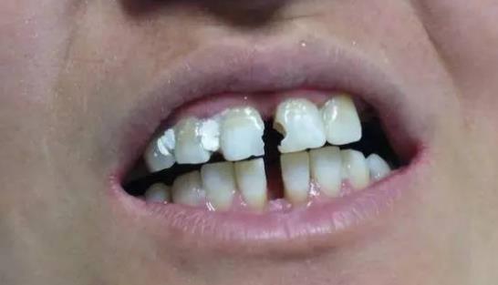 怎么預(yù)防牙縫變大?牙縫變大可以怎么辦?