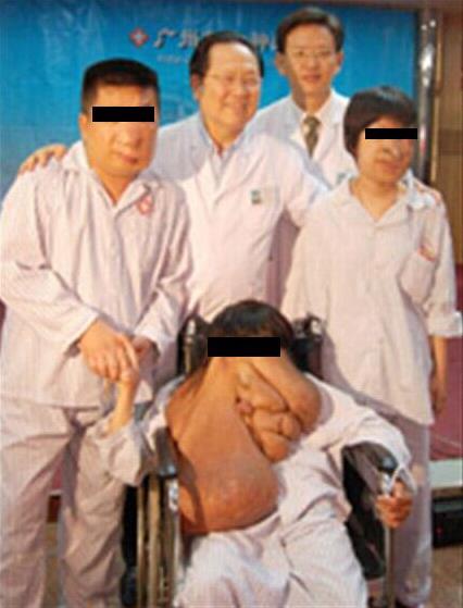 廣州腫瘤專家,黃春才成功治療案例