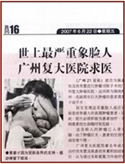 廣州腫瘤專家,黃春才成功治療案例