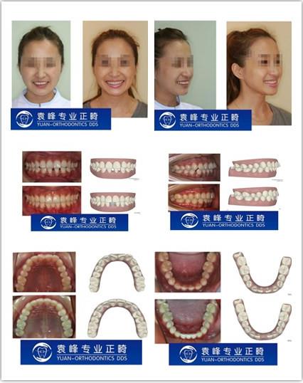 牙套故事:十年前免費做隱適美的女孩,現在怎么樣了?