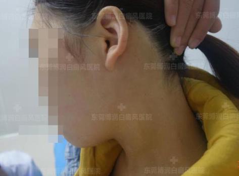 東莞博潤醫(yī)院白癜風如何預約?為何白癜風出現(xiàn)后要及時進行治療