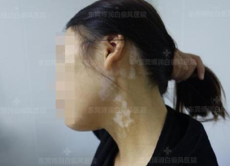 東莞博潤醫(yī)院白癜風如何預約?為何白癜風出現(xiàn)后要及時進行治療