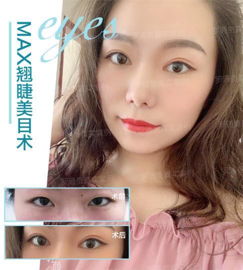 成都潤美玉之光羅通貴院長專業嗎 打造只屬于你的眼