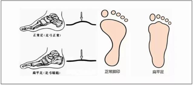 緩解扁平足的疼痛,穿著矯正鞋墊進行運動鍛煉,更有效