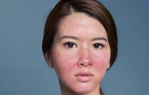 為什么會(huì)患激素臉?激素臉與過(guò)敏的區(qū)別有哪些?